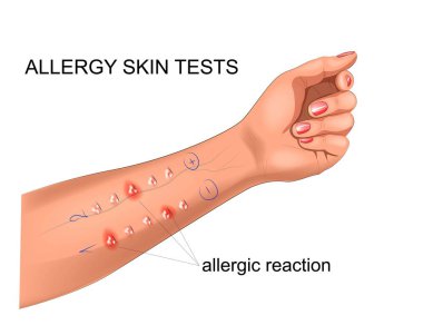 vektör çizim çalışma kazıma testi için alerji