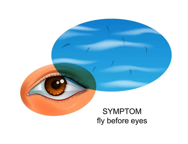 Ilustración Vectorial Una Mosca Delante Los Ojos Síntoma Enfermedades Oculares — Vector de stock