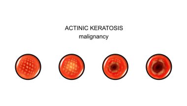 aktinik keratoz vektör Illustration. malignization. kanser