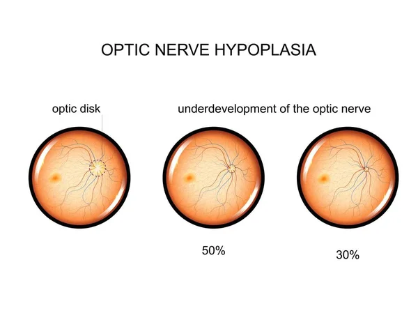 Ilustração Vetorial Hipoplasia Nervo Óptico Oftalmologia — Vetor de Stock