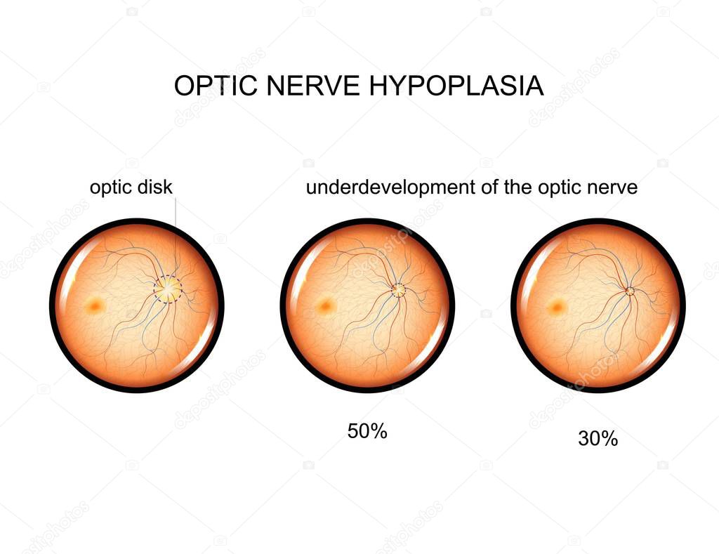 vector illustration of optic nerve hypoplasia. ophthalmology