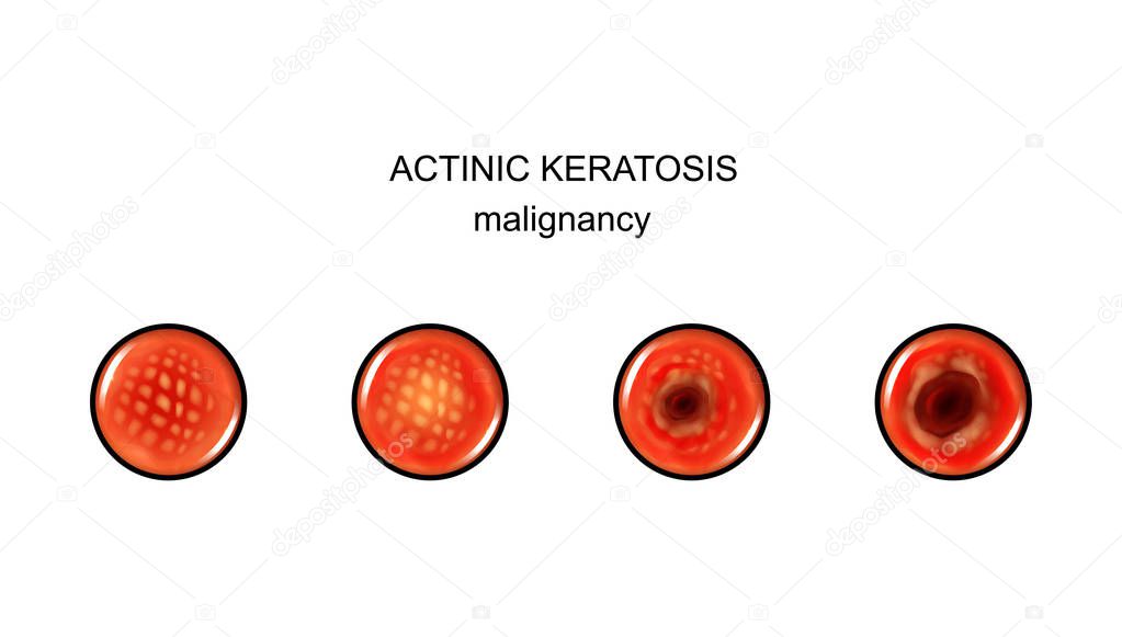 vector illustration of actinic keratosis. malignization. cancer