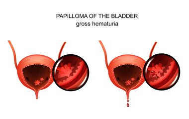 vector illustration of a papilloma in the urinary bladder clipart