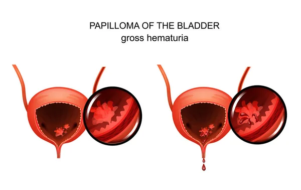 Vector illustration of a papilloma in the urinary bladder — Stock Illustration Vector Illustration Papilloma Urinary Bladder Stock Illustration
