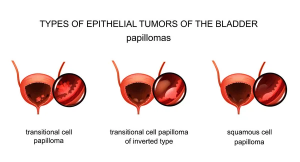 Illustration Vectorielle Des Tumeurs Épithéliales Vessie Urologie — Image vectorielle