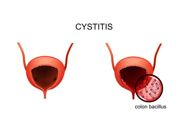 Illustrazione Vettoriale Dell Infiammazione Della Vescica Causata Coli — Vettoriale Stock