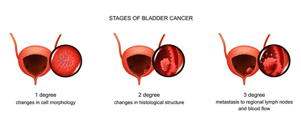 Vector illustration of the stage of bladder cancer — Stock Illustration Vector Illustration Stage Bladder Cancer Royalty Free Stock Illustrations