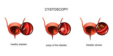 vector illustration of cystoscopy of the bladder. stones in the bladder and a polyp. clipart
