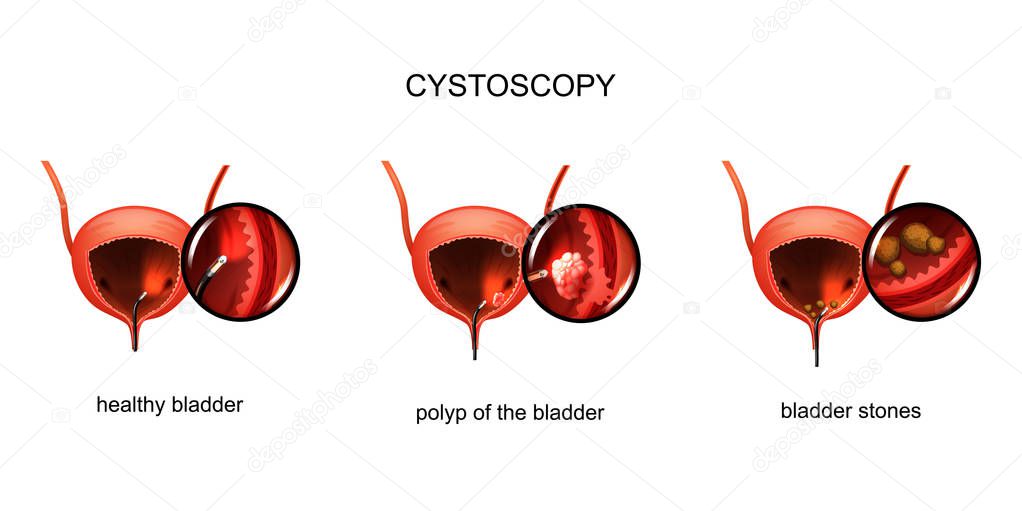 vector illustration of cystoscopy of the bladder. stones in the bladder and a polyp.