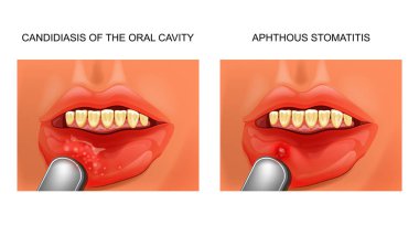 vector illustration of a candidiasis, and aphthous stomatitis clipart
