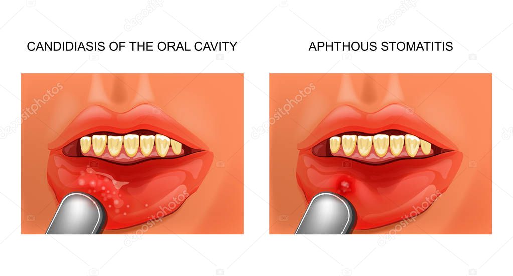 vector illustration of a candidiasis, and aphthous stomatitis