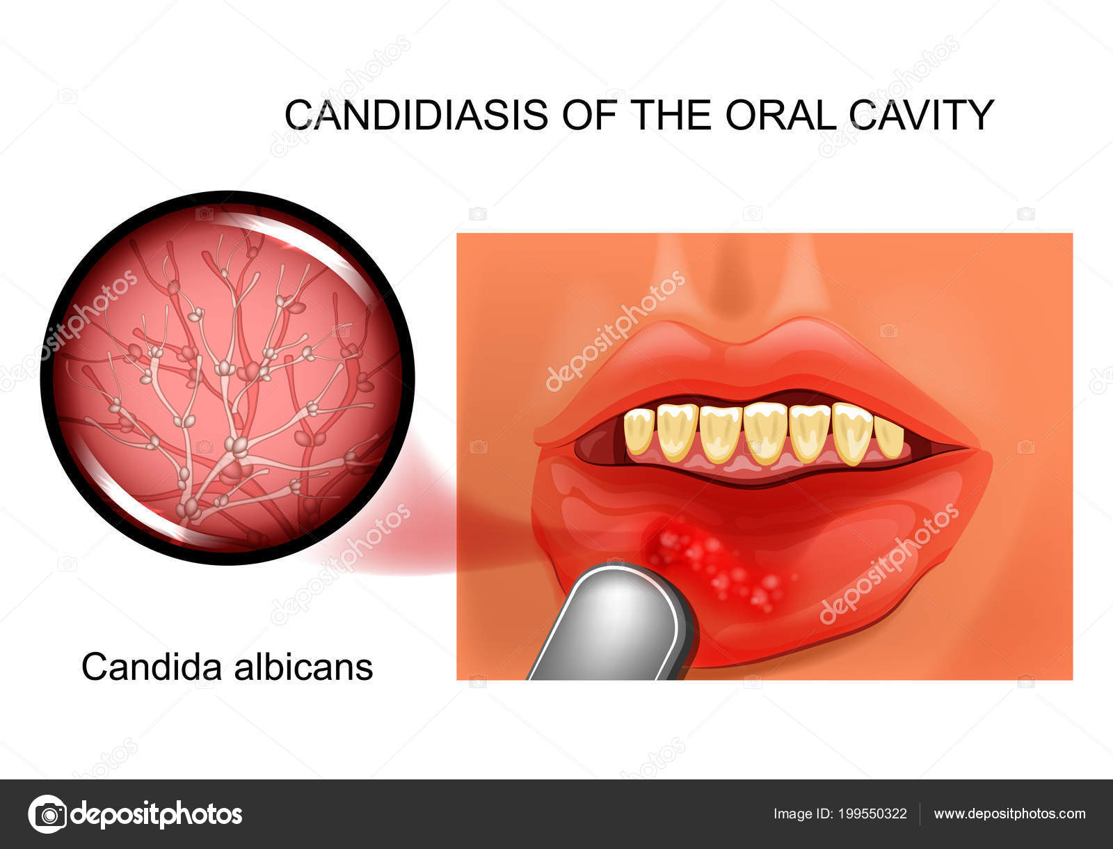 Por infeccion candida albicans bucal