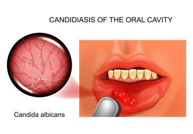 oral kandidiyaz vektör Illustration. etken Candida albicans