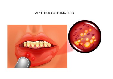 vector illustration of aphthous stomatitis. aphthae in the oral mucosa clipart