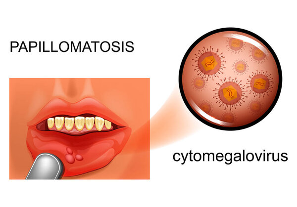 vector illustration of oral mucosal papillomatosis. cytomegalovirus