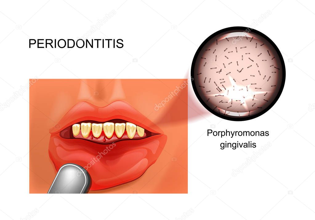 vector illustration of periodontitis. bleeding gums. stomatology