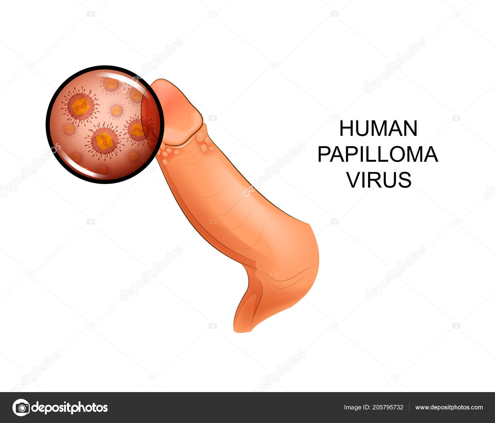 Human papillomavirus infection in males