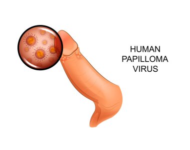vector illustration of human papilloma virus on penis
