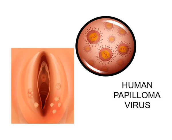 Ilustración Vectorial Del Virus Del Papiloma Humano Los Genitales Femeninos — Vector de stock