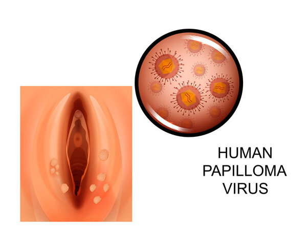 vector illustration of human papilloma virus on female genitals