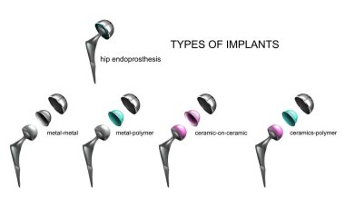 implantlar malzeme türüne göre tür vektör çizim