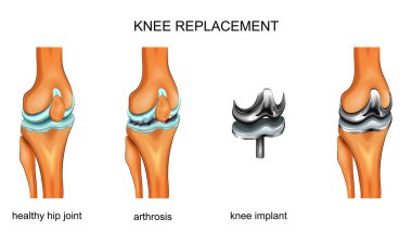 vector illustration of a total knee replacement clipart