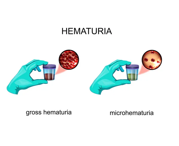 Ilustração Vetorial Hematúria Sangue Urina — Vetor de Stock