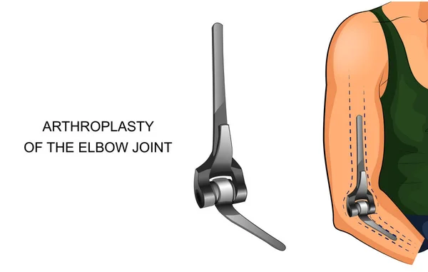 Vector Εικονογράφηση Από Endoprosthesis Της Άρθρωσης Του Αγκώνα — Διανυσματικό Αρχείο