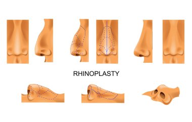 vector illustration of the nose. rhinoplasty. plastic surgery clipart