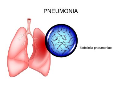 pnömoni vektör Illustration. etken - Klebsiella