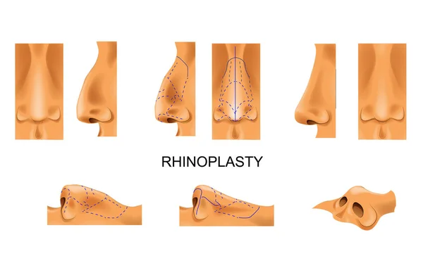 Векторная Иллюстрация Носа Ринопластика Пластическая Хирургия — стоковый вектор