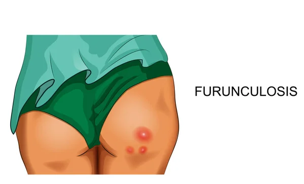 Ilustración Vectorial Furunculosis Las Nalgas Femeninas — Vector de stock