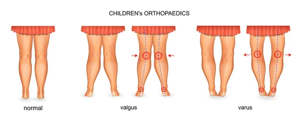 Vector Illustration Pediatric Orthopedics Valgus Varus — Stock Vector