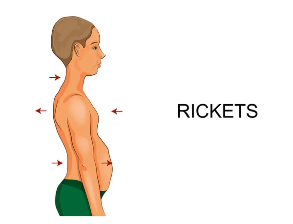 Vectorillustratie Van Een Jongen Met Tekenen Van Rachitis — Stockvector