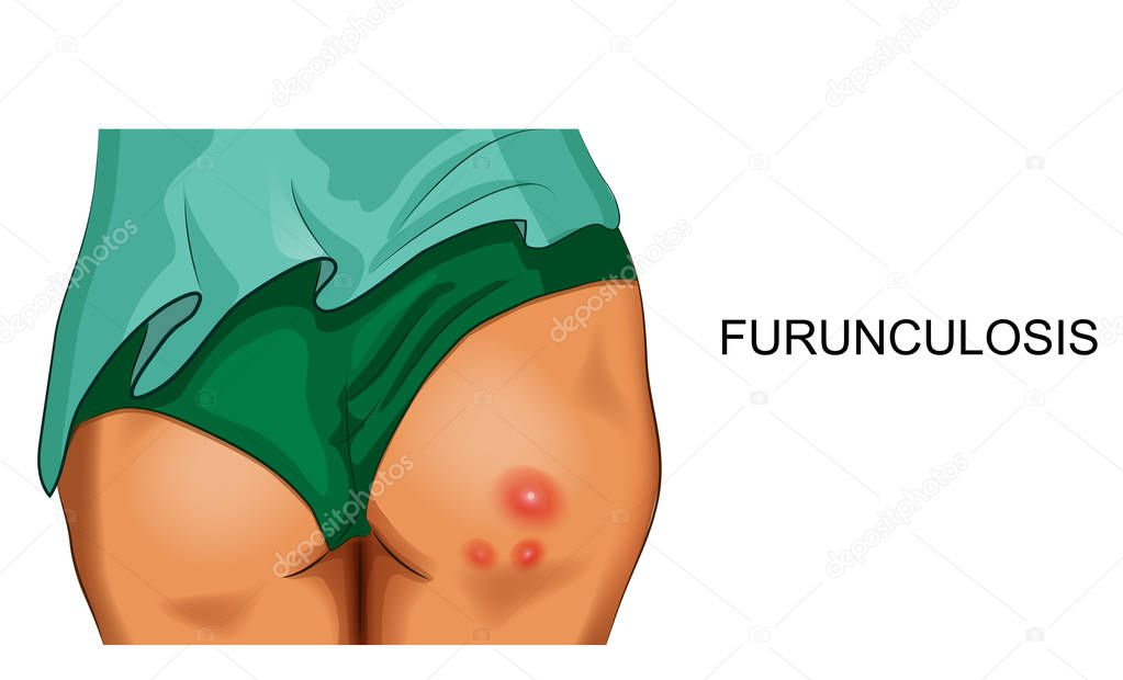 vector illustration of furunculosis on female buttocks