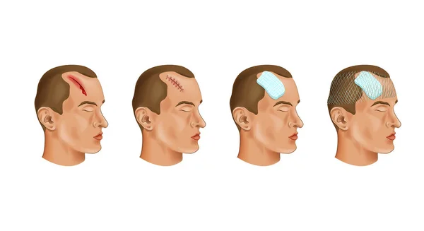 Векторная Иллюстрация Медицинской Повязки Голове — стоковый вектор