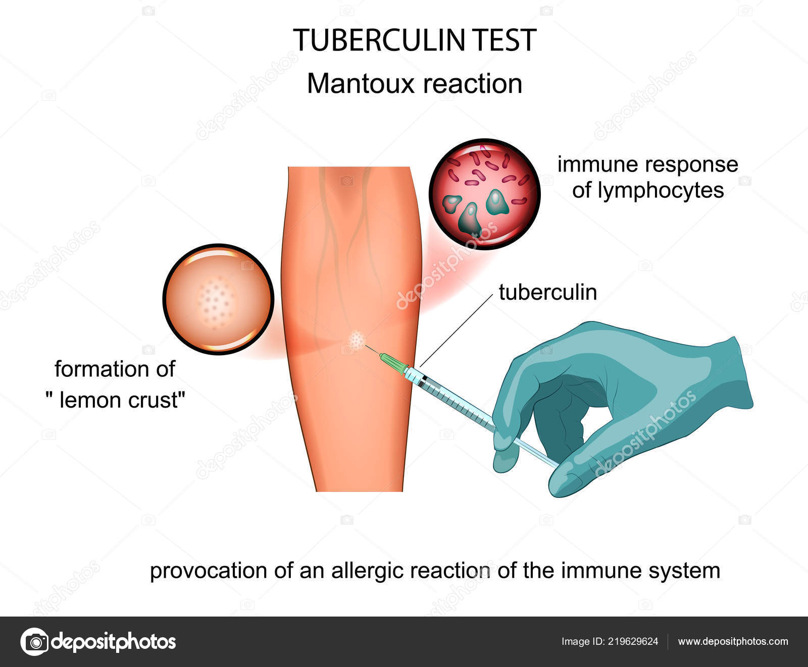 Сколько дней нельзя мочить манту у ребенка 2 лет. Можно ли мочить прививку манту. Можно ли мочить прививку манту. Реакция манту это живая вакцина. Можно ли мочить прививку манту.