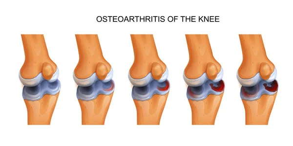 Vektorové Ilustrace Osteoartrózy Kolenního Kloubu — Stockový vektor