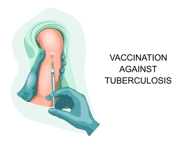 Vector Ilustración Vacunación Infantil Contra Tuberculosis — Archivo Imágenes Vectoriales