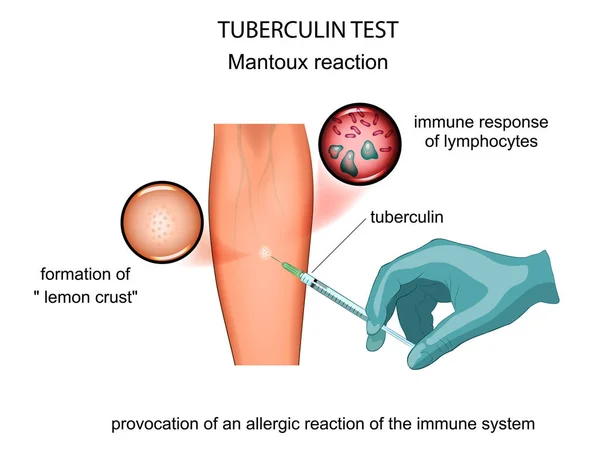 Ilustración Vectorial Una Muestra Tuberculina Mantoux — Vector de stock