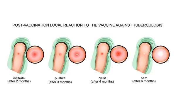 Tüberküloz Karşı Aşı Sonrası Aşı Tepkiler Vektör Çizim — Stok Vektör