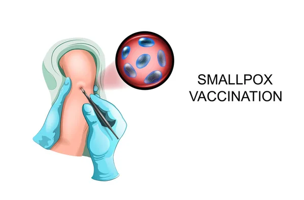 Vectorillustratie Van Vaccinatie Van Een Kind Tegen Pokken — Stockvector