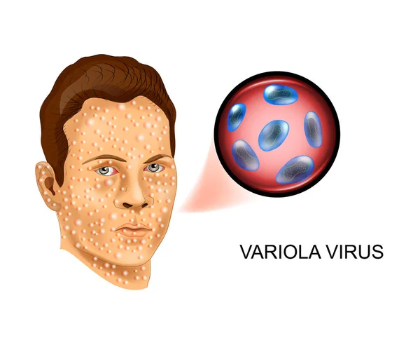 Vector Illustration Smallpox Virus Defeat Face — Stock Vector