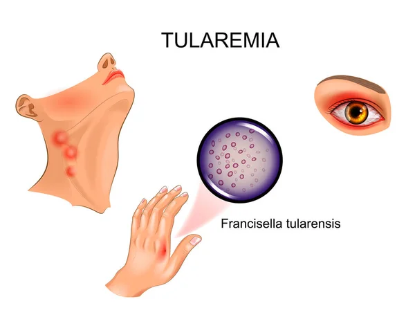 Ilustración Vectorial Tularemia Mordida Mano Linfadenitis Conjuntivitis — Archivo Imágenes Vectoriales