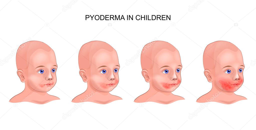 vector illustration of pyoderma on a child's face