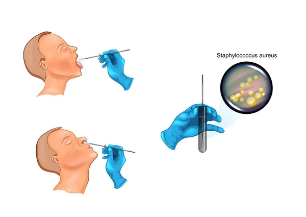 Vector Illustration Swab Nose Throat — Stock Vector