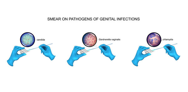 vector illustration of urological smear. candidiasis, vaginosis, chlamydia