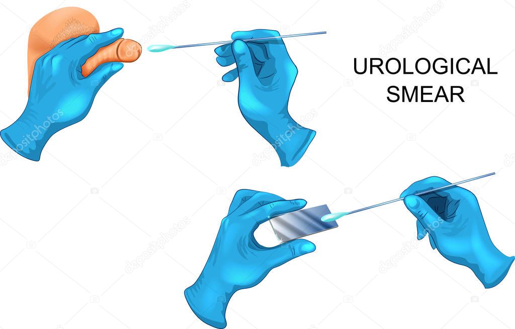 vector illustration of swabbing from the urethra of the penis