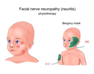 vector illustration of physiotherapy Bergony mask of facial nerve neuritis in a child clipart