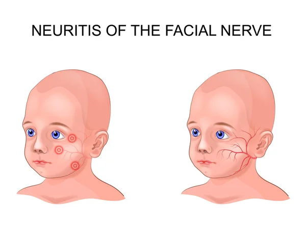 Ilustração Vetorial Neurite Nervo Facial Uma Criança — Vetor de Stock